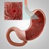 Gastritis, ili erozije želuca: glavni simptomi, liječenje, prehrana