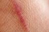 Ožiljci na koži: što je to i kako ih ukloniti