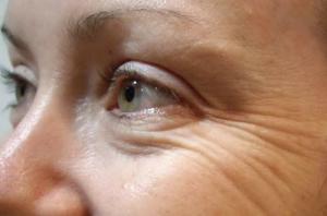 Kako spriječiti pojavu bora oko očiju