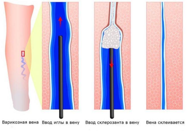 Shema flebosklerozirovaniya 