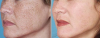 Najbolji lijek za pigmentaciju na licu, vratu i dekoltea. Učinak je vidljiv odmah nakon 1. korištenje