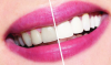 Kako izbijeliti zube kod kuće? zubni savjet.