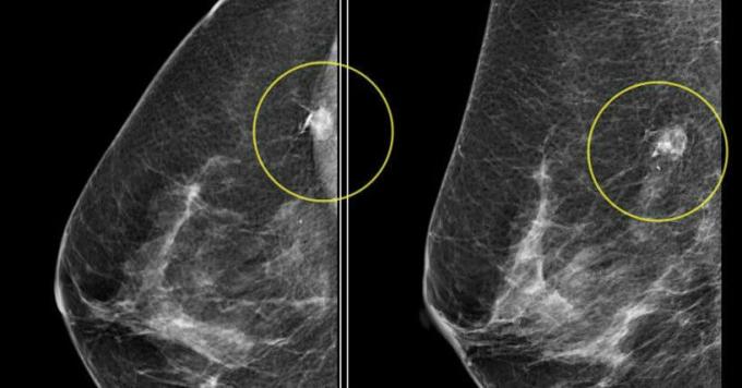 raka dojke - rak dojke