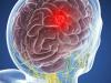 Mozak tumora: 5 simptomi koji se ne može ignorirati